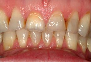 Lindenbrook Dental Care | Veneers, Dentures and Invisalign reg 