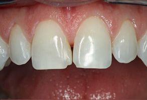 Lindenbrook Dental Care | Implant Dentistry, Extractions and Dental Bridges